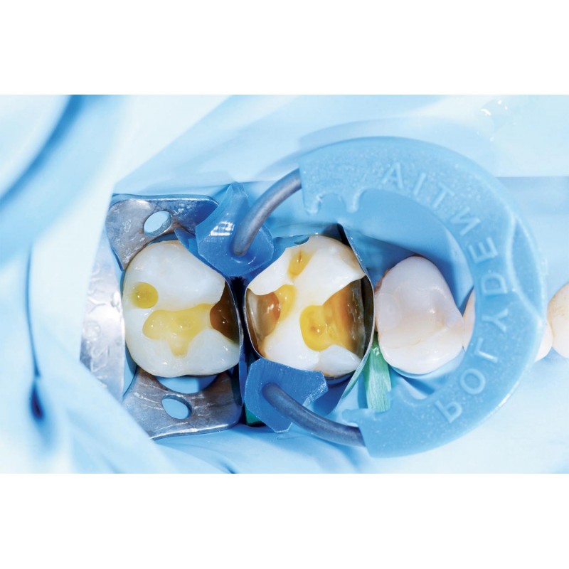 Diamond24 силиконовые втулки 6312 op.15 par Polydentia