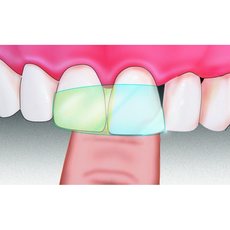 Клейкие ленты Anterior Dispens-O-Mat op.100шт. Polydentia