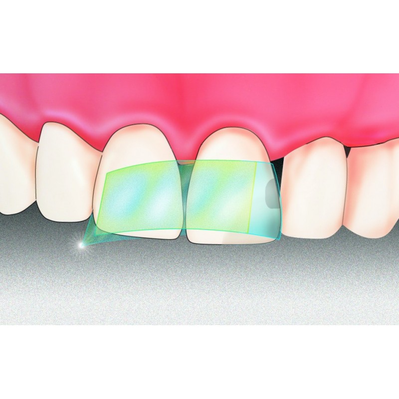 Клейкие ленты Anterior Dispens-O-Mat op.100шт. Polydentia